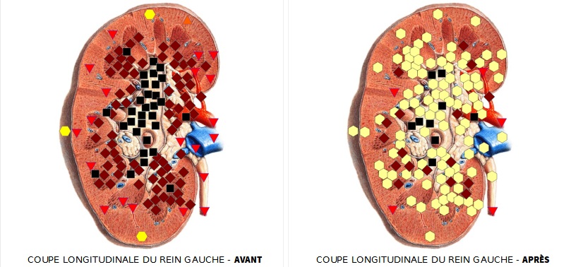 coupe longitudinale du rein avant et après