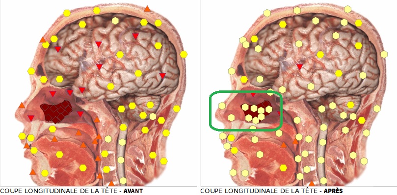 coupe longitudinale de la tête avant et après