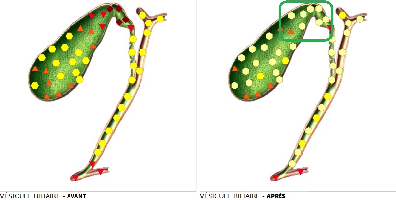 vésicule biliaire avant et après